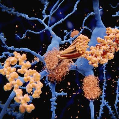 Blood test method may predict amyloid deposits in brain, .